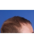 After Hair Transplant&nbsp;Front
